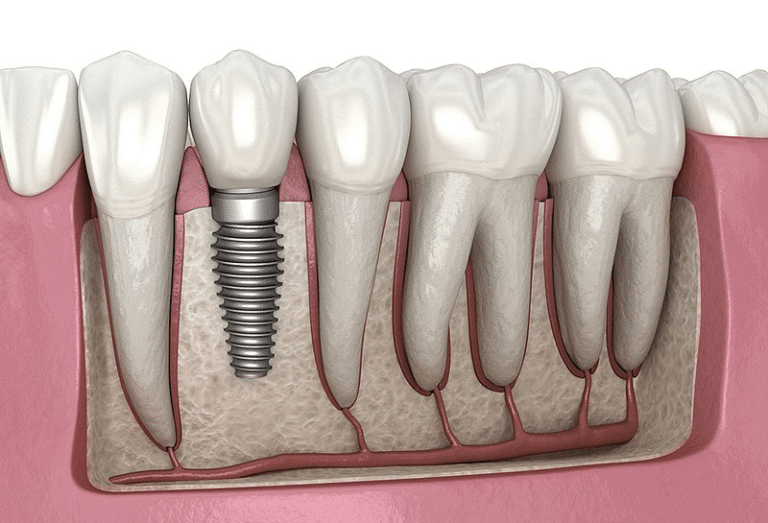 10 Things to Consider Before Going for a Full Set of Teeth in Turkey